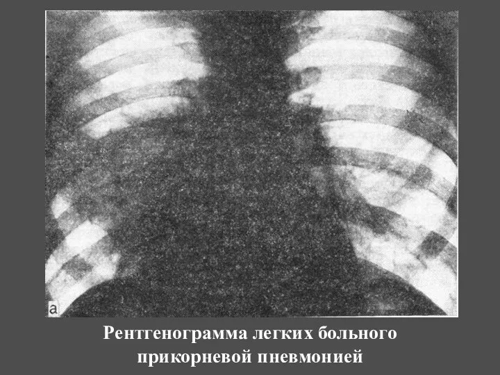 Рентгенограмма легких больного прикорневой пневмонией