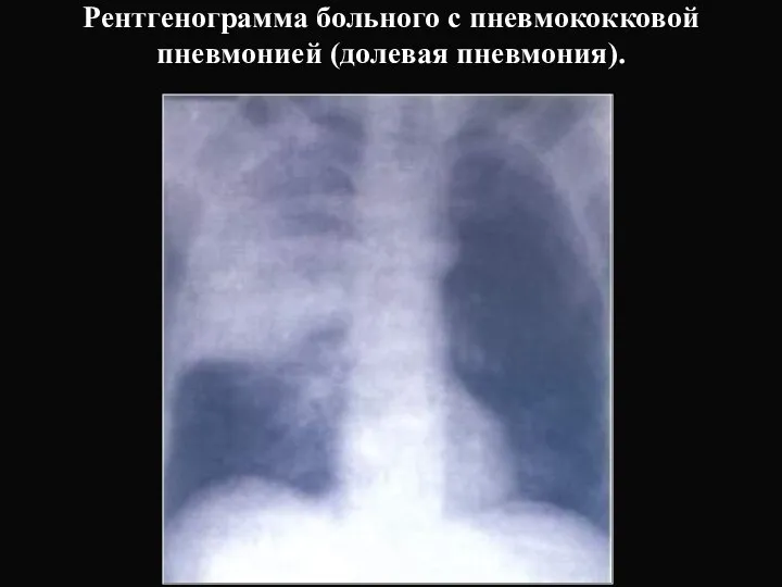 Рентгенограмма больного с пневмококковой пневмонией (долевая пневмония).