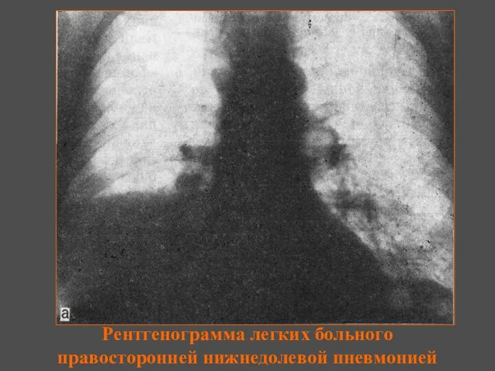 Рентгенограмма легких больного правосторонней нижнедолевой пневмонией