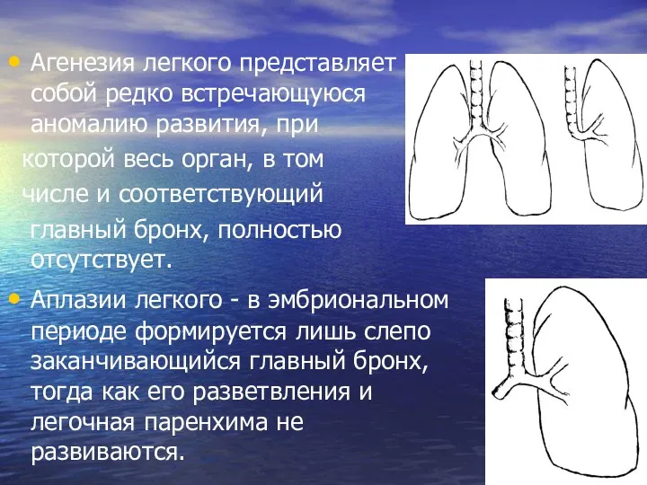 Агенезия легкого представляет собой редко встречающуюся аномалию развития, при которой весь орган, в