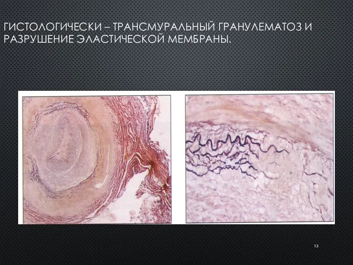 ГИСТОЛОГИЧЕСКИ – ТРАНСМУРАЛЬНЫЙ ГРАНУЛЕМАТОЗ И РАЗРУШЕНИЕ ЭЛАСТИЧЕСКОЙ МЕМБРАНЫ.