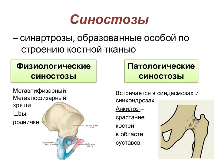 Синостозы – синартрозы, образованные особой по строению костной тканью Физиологические синостозы Патологические синостозы