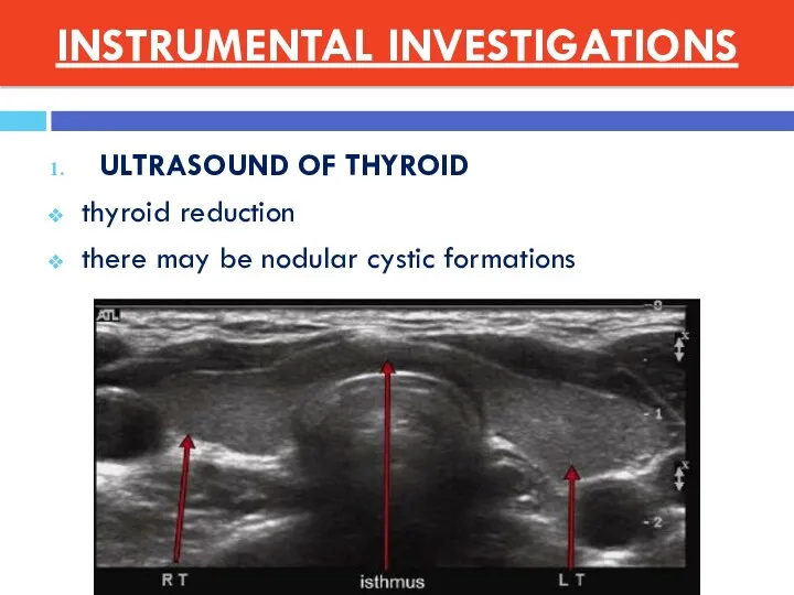 INSTRUMENTAL INVESTIGATIONS ULTRASOUND OF THYROID thyroid reduction there may be nodular cystic formations