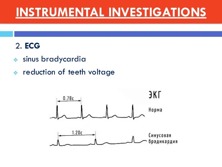 2. ECG sinus bradycardia reduction of teeth voltage INSTRUMENTAL INVESTIGATIONS