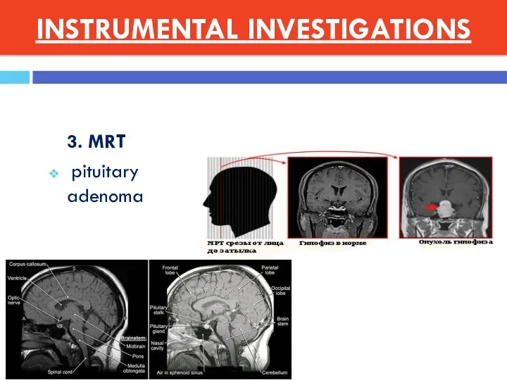 3. MRT pituitary adenoma INSTRUMENTAL INVESTIGATIONS