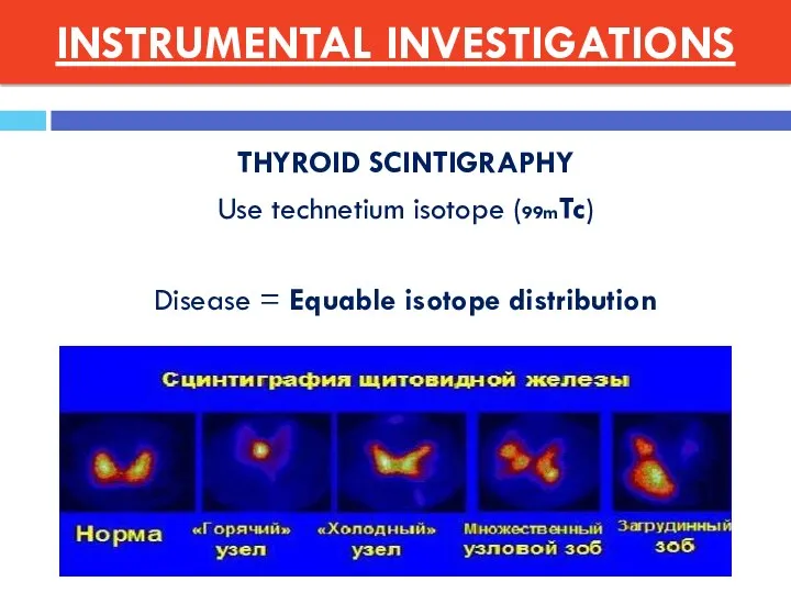THYROID SCINTIGRAPHY Use technetium isotope (99mTc) Disease = Equable isotope distribution INSTRUMENTAL INVESTIGATIONS