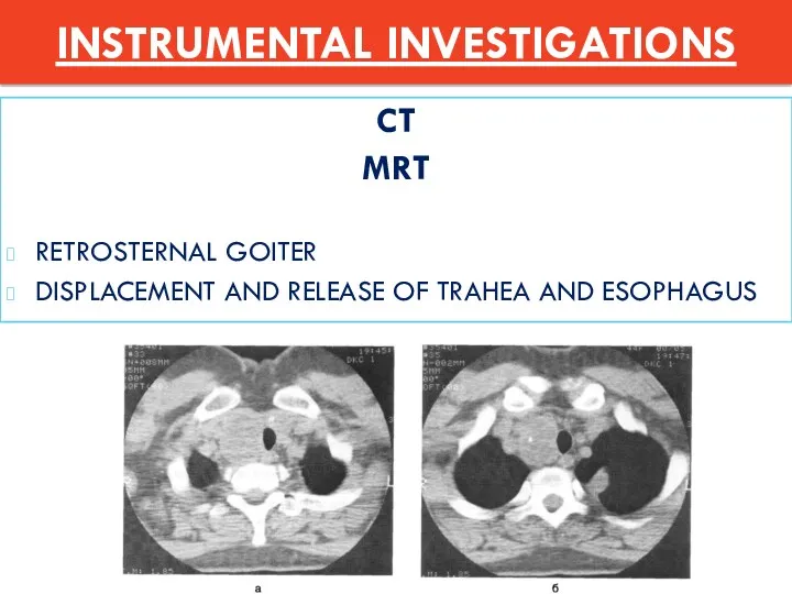 CT MRT RETROSTERNAL GOITER DISPLACEMENT AND RELEASE OF TRAHEA AND ESOPHAGUS INSTRUMENTAL INVESTIGATIONS