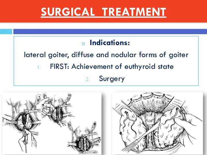 SURGICAL TREATMENT Indications: lateral goiter, diffuse and nodular forms of goiter FIRST: Achievement