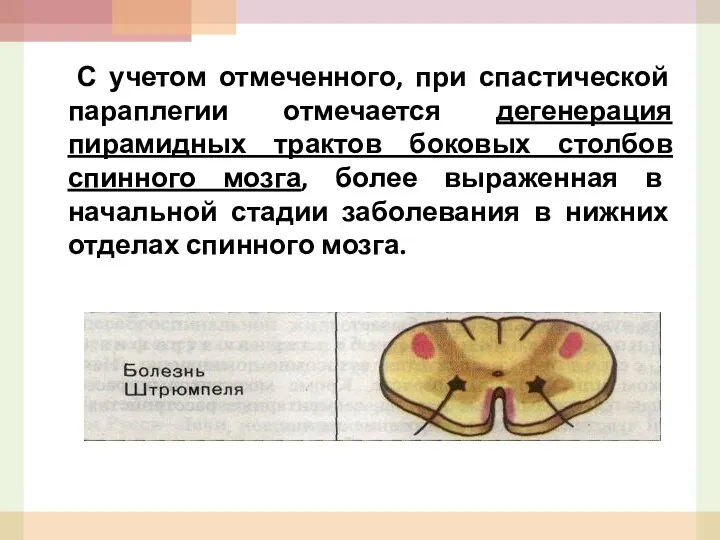 С учетом отмеченного, при спастической параплегии отмечается дегенерация пирамидных трактов