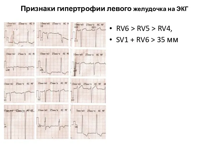 Признаки гипертрофии левого желудочка на ЭКГ RV6 > RV5 > RV4, SV1 +