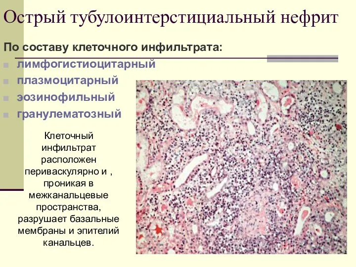 Острый тубулоинтерстициальный нефрит По составу клеточного инфильтрата: лимфогистиоцитарный плазмоцитарный эозинофильный