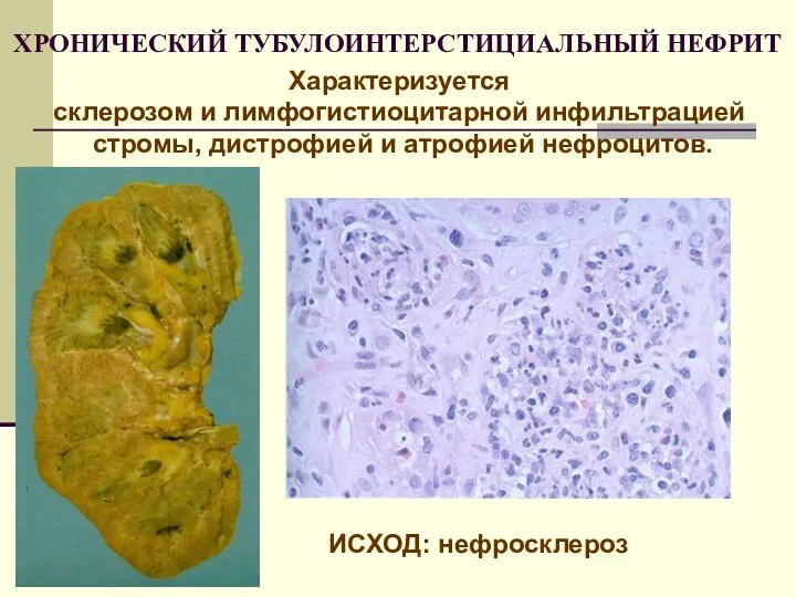 ХРОНИЧЕСКИЙ ТУБУЛОИНТЕРСТИЦИАЛЬНЫЙ НЕФРИТ Характеризуется склерозом и лимфогистиоцитарной инфильтрацией стромы, дистрофией и атрофией нефроцитов. ИСХОД: нефросклероз