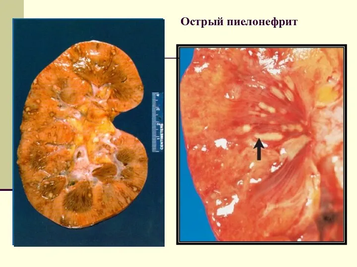 Острый пиелонефрит