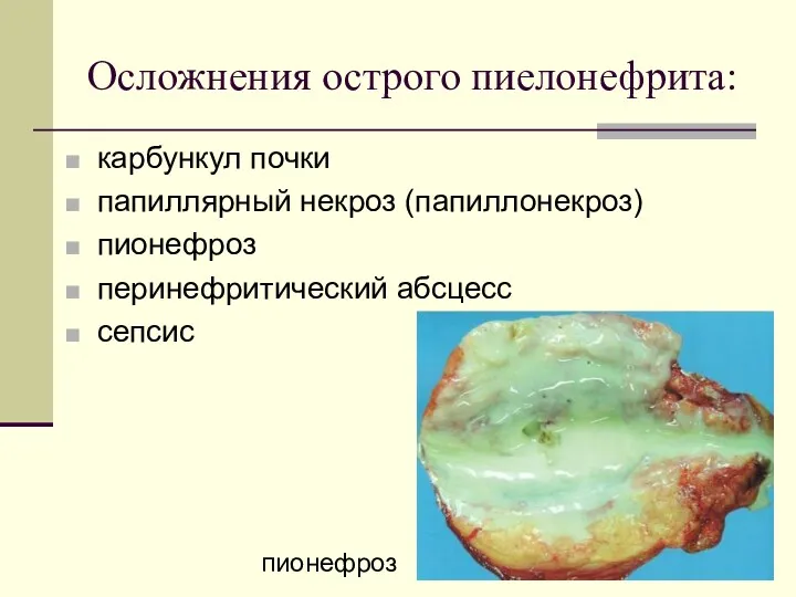 Осложнения острого пиелонефрита: карбункул почки папиллярный некроз (папиллонекроз) пионефроз перинефритический абсцесс сепсис пионефроз