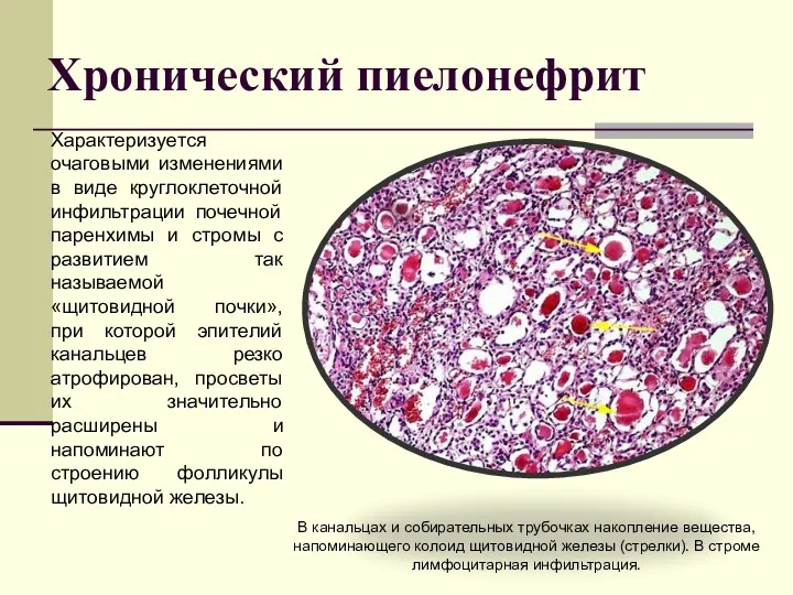 Хронический пиелонефрит Характеризуется очаговыми изменениями в виде круглоклеточной инфильтрации почечной