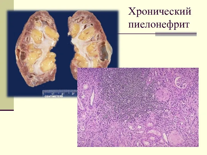 Хронический пиелонефрит