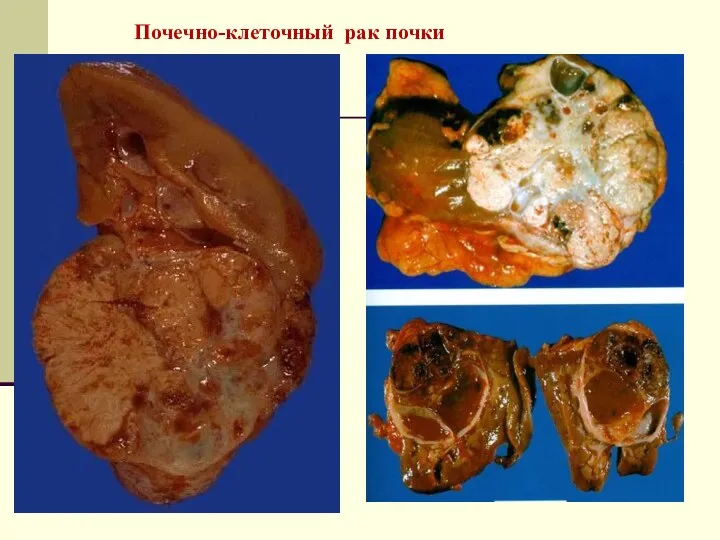 Почечно-клеточный рак почки