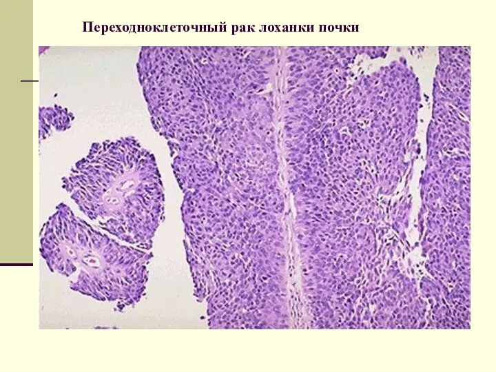 Переходноклеточный рак лоханки почки