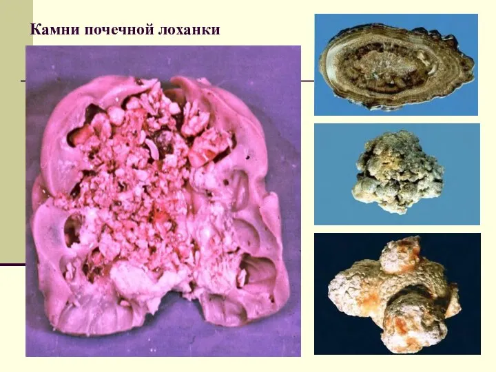 Камни почечной лоханки