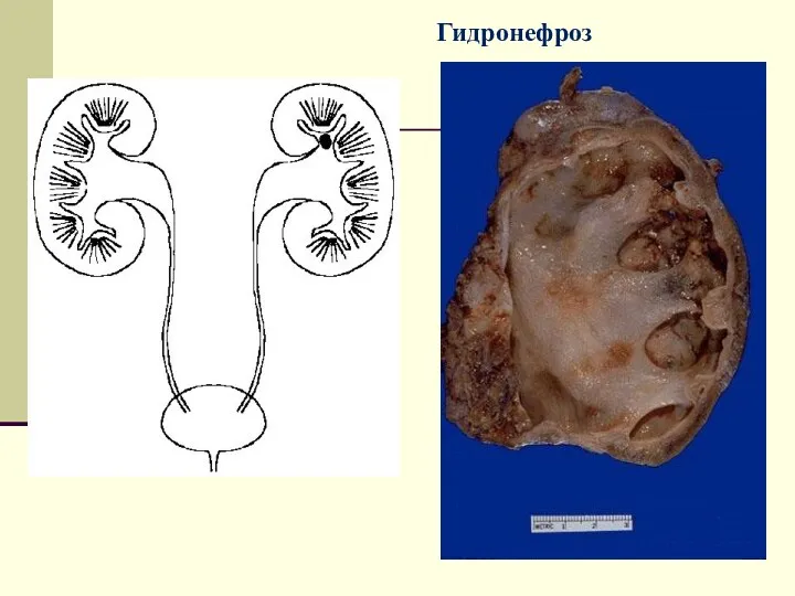 Гидронефроз