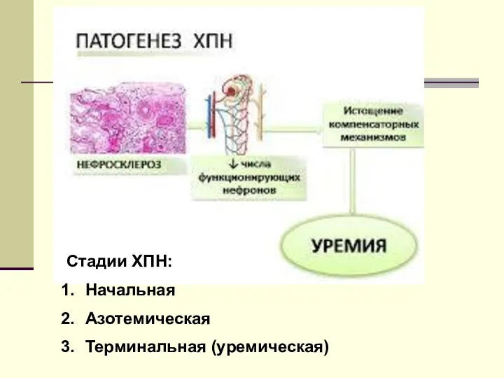 Стадии ХПН: Начальная Азотемическая Терминальная (уремическая)