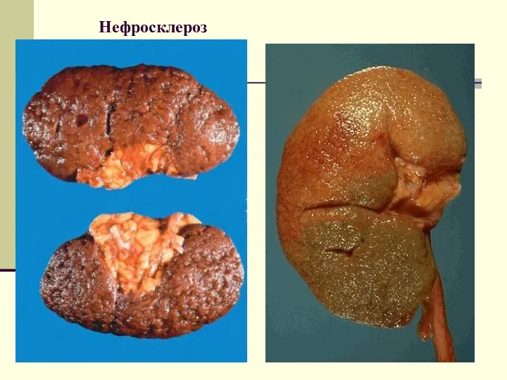 Нефросклероз