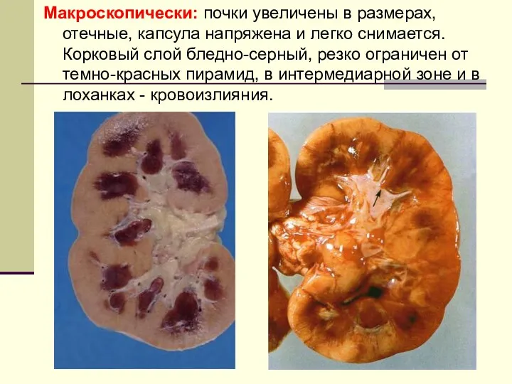 Макроскопически: почки увеличены в размерах, отечные, капсула напряжена и легко