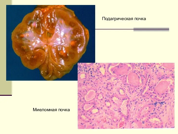 Подагрическая почка Миеломная почка