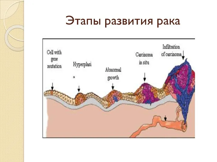 Этапы развития рака