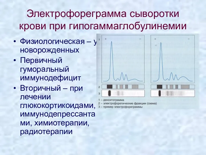 Электрофореграмма сыворотки крови при гипогаммаглобулинемии Физиологическая – у новорожденных Первичный