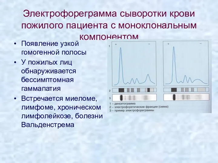 Электрофореграмма сыворотки крови пожилого пациента с моноклональным компонентом Появление узкой