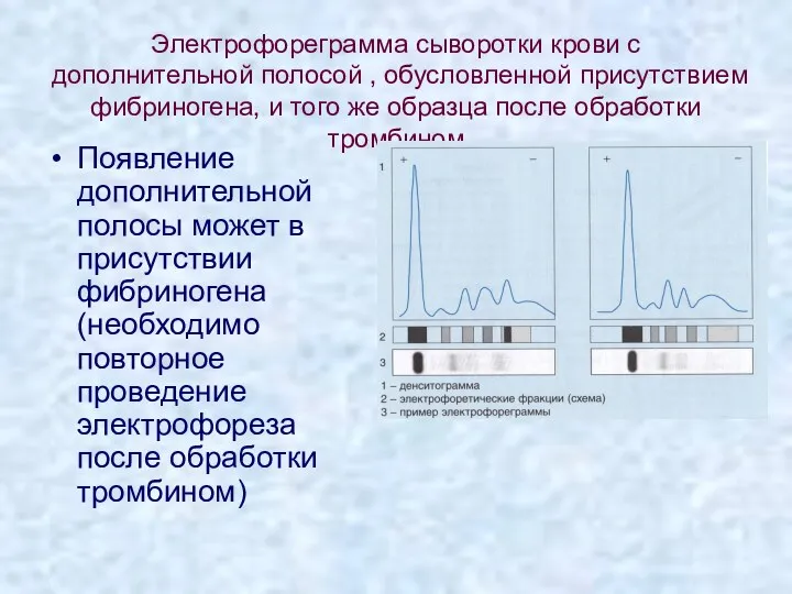 Электрофореграмма сыворотки крови с дополнительной полосой , обусловленной присутствием фибриногена,