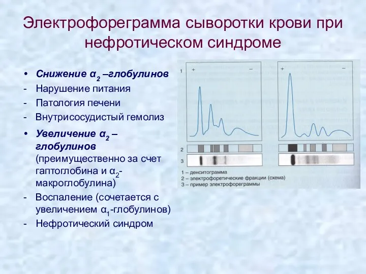 Электрофореграмма сыворотки крови при нефротическом синдроме Снижение α2 –глобулинов Нарушение