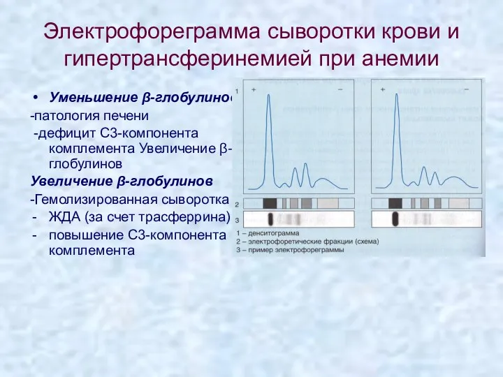 Электрофореграмма сыворотки крови и гипертрансферинемией при анемии Уменьшение β-глобулинов -патология