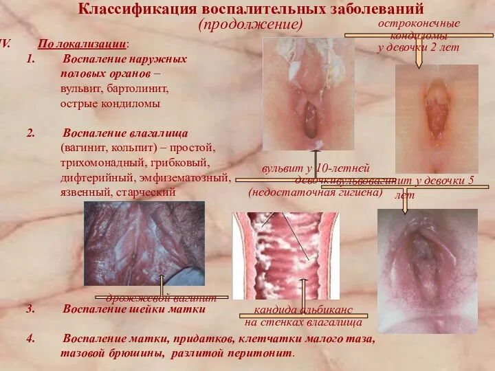 По локализации: Воспаление наружных половых органов – вульвит, бартолинит, острые кондиломы Воспаление влагалища