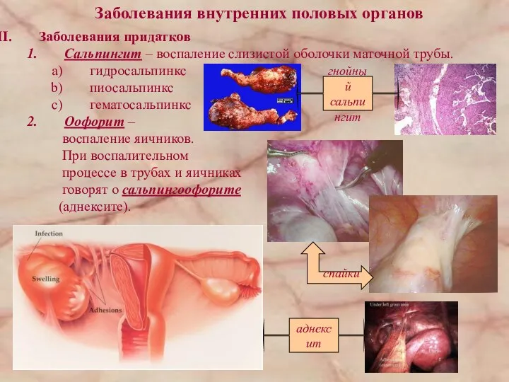 Заболевания внутренних половых органов Заболевания придатков Сальпингит – воспаление слизистой оболочки маточной трубы.