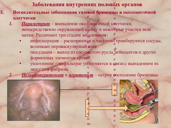 Заболевания внутренних половых органов Воспалительные заболевания тазовой брюшины и околоматочной клетчатки Параметрит –