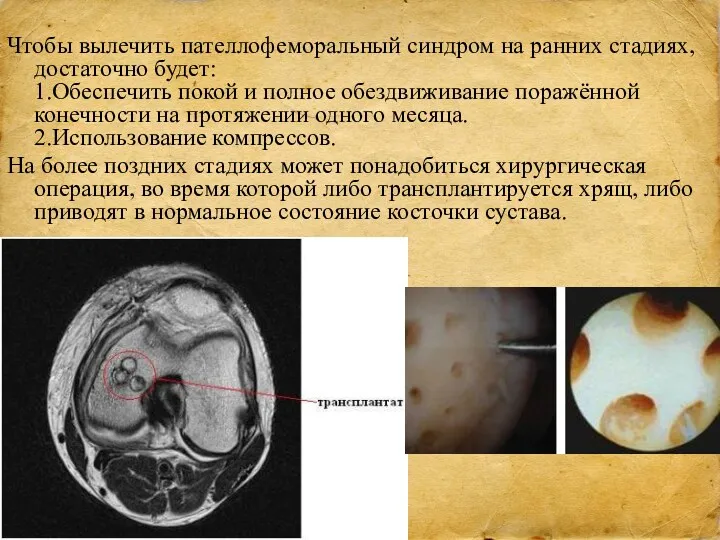 Чтобы вылечить пателлофеморальный синдром на ранних стадиях, достаточно будет: 1.Обеспечить