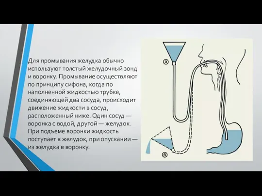 Для промывания желудка обычно используют толстый желудочный зонд и воронку.