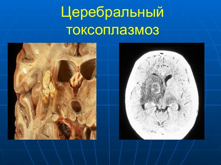 Церебральный токсоплазмоз