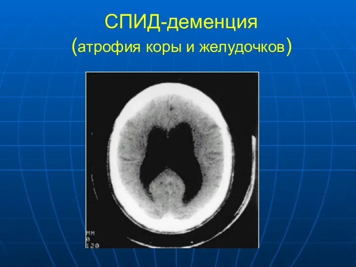 СПИД-деменция (атрофия коры и желудочков)