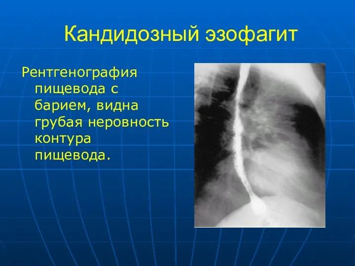 Кандидозный эзофагит Рентгенография пищевода с барием, видна грубая неровность контура пищевода.