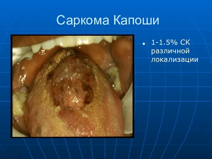 Саркома Капоши 1-1.5% CК различной локализации