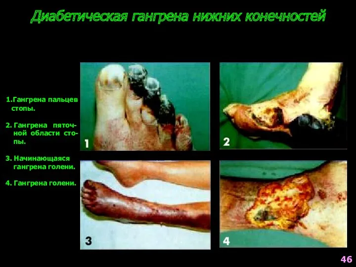 Диабетическая гангрена нижних конечностей 1.Гангрена пальцев стопы. 2. Гангрена пяточ-