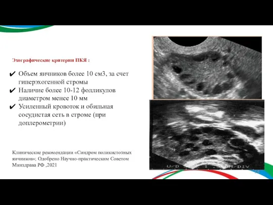 Эхографические критерии ПКЯ : Объем яичников более 10 см3, за