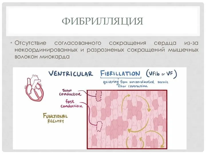 ФИБРИЛЛЯЦИЯ Отсутствие согласованного сокращения сердца из-за некоординированных и разрозненых сокращений мышечных волокон миокарда