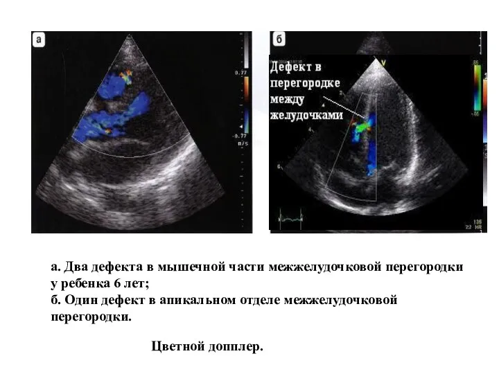 а. Два дефекта в мышечной части межжелудочковой перегородки у ребенка