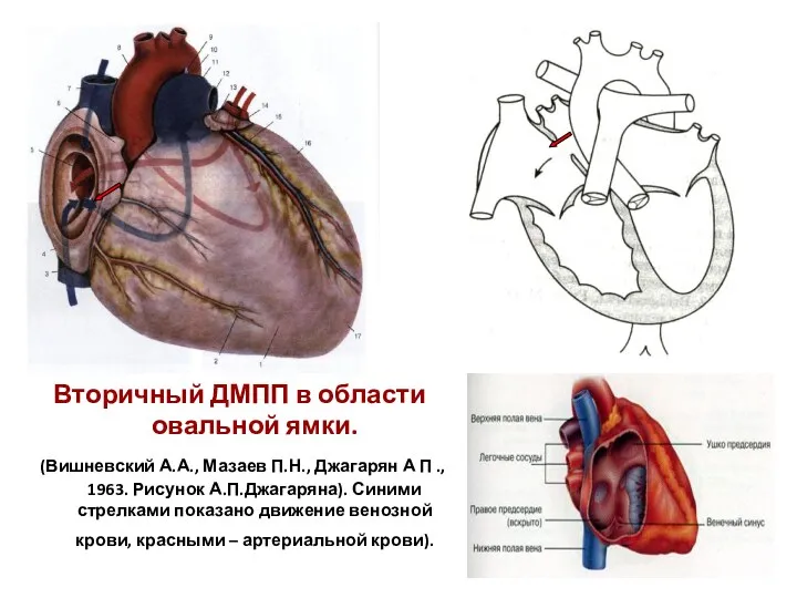 Вторичный ДМПП в области овальной ямки. (Вишневский А.А., Мазаев П.Н.,