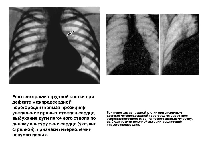 Рентгенограмма грудной клетки при дефекте межпредсердной перегородки (прямая проекция): увеличение