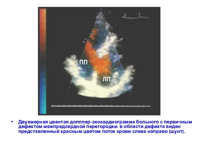 Двухмерная цвентая допплер-эхокардиограмма больного с первичным дефектом межпредсердной перегородки: в